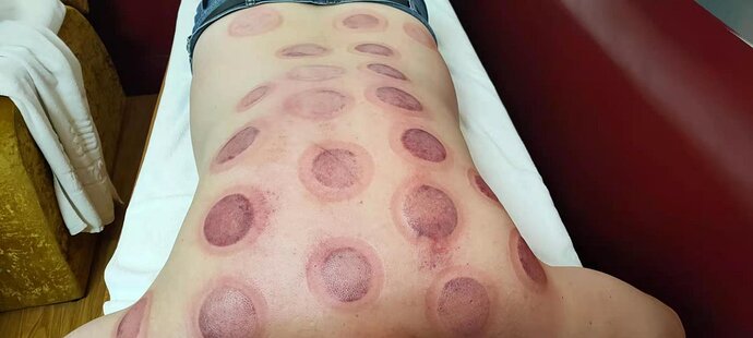 cupping
