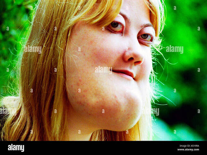 a-young-woman-with-cherubism-the-rare-genetic-condition-is-a-hereditary-A519RA